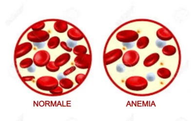 illustrazione scientifica di globuli rossi sani e globuli rossi scarsi a causa dell'anemia sideropenica